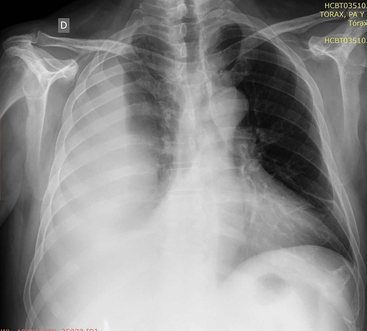 Empiema pleural por E coli en postoperatorio colecistitis.jpg